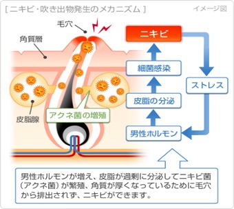 ニキビの原因と種類