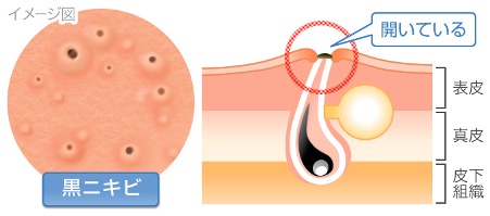 黒ニキビ イメージ