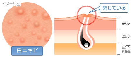 白ニキビ イメージ