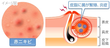 赤ニキビ イメージ