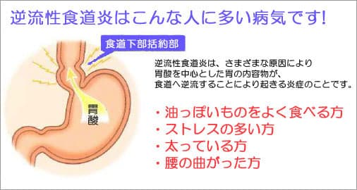 逆流性食道炎になりやすい方