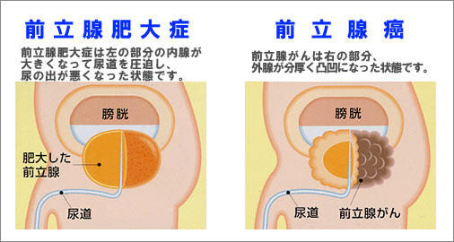 BPH と前立腺がんの治療法