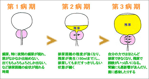 トイレ に ない 夜 方法 起き