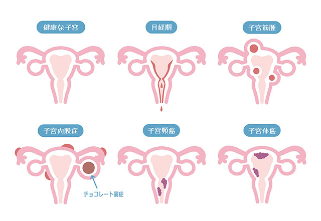 子宮内膜症イメージ